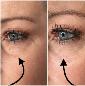 under eye filler for dark circles before and after