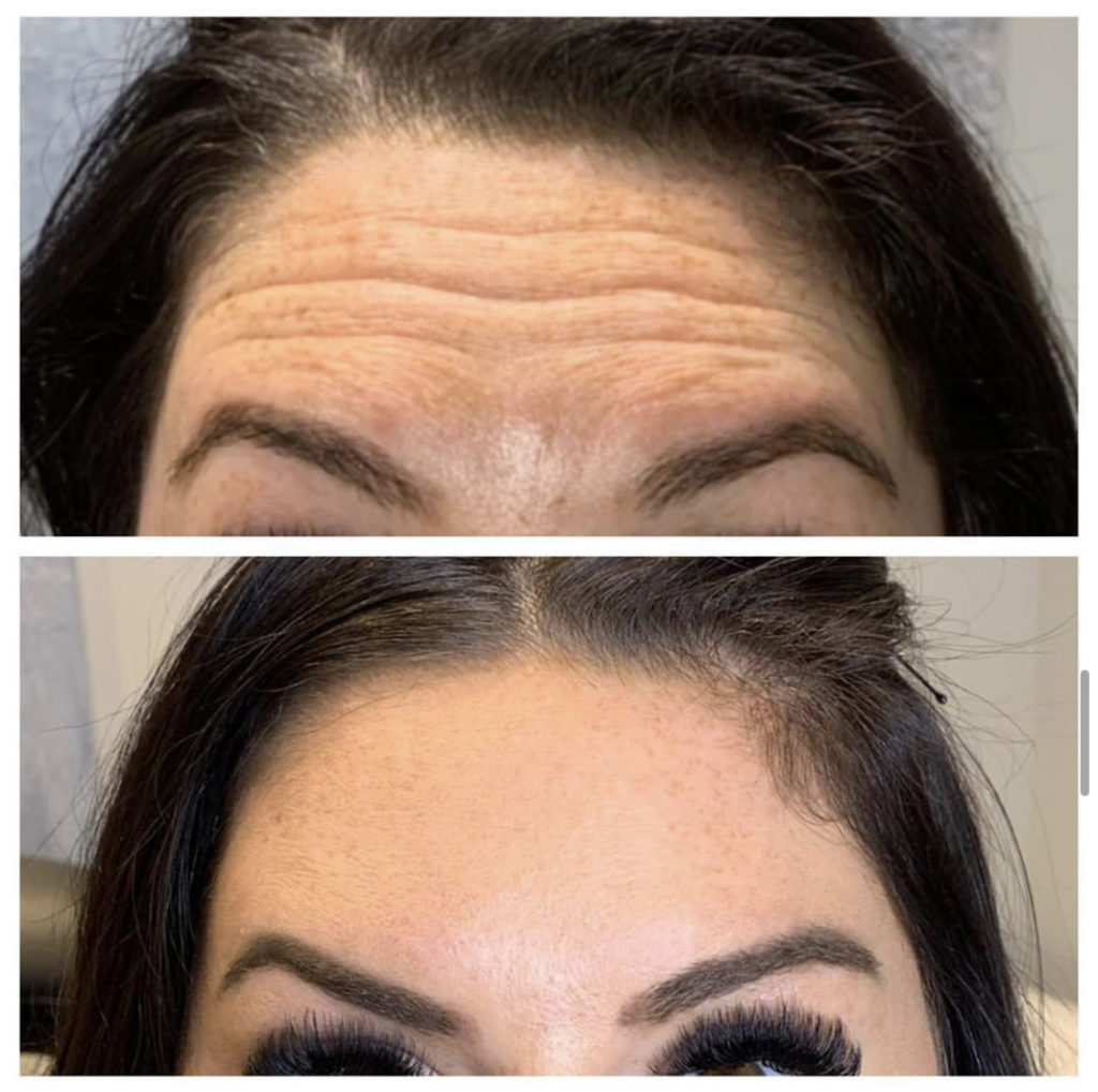 botox on womans forehead