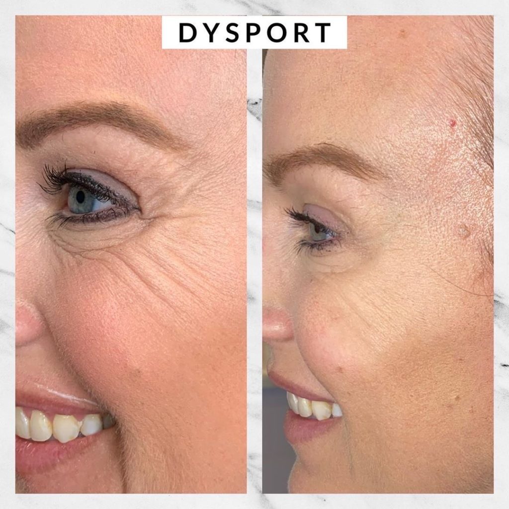 Dysport crows feet 2