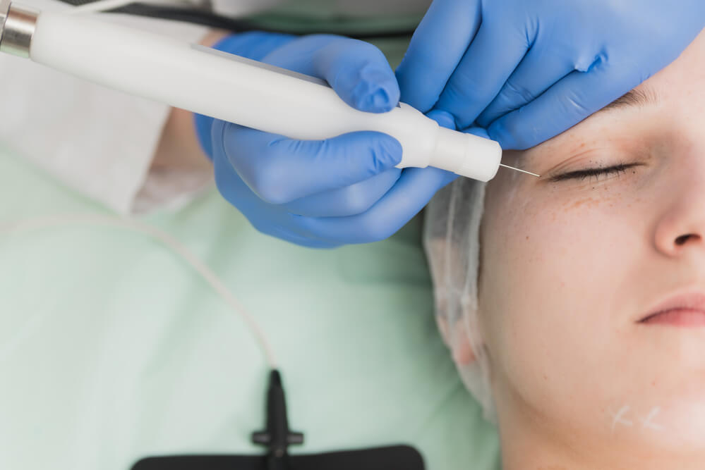 patient receiving plasma fibroblast procedure for eyelid skin firming