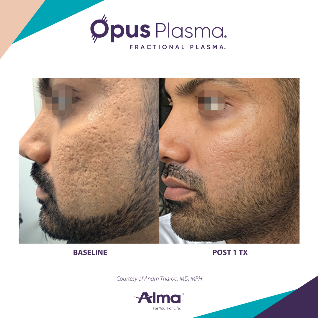 Opus Plasma treatment before and after